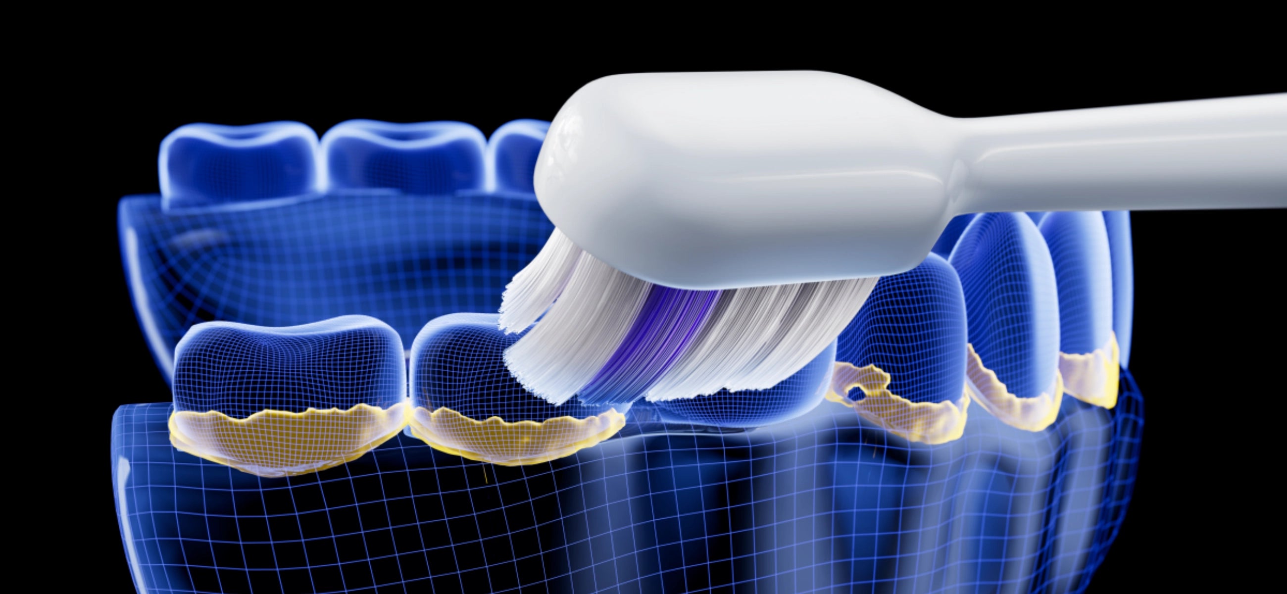 Plaque and Tartar: Causes and Prevention